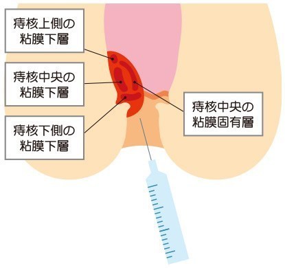 【中古】 痔はこれで治せる いぼ痔・きれ痔・あな痔・大腸がんを知る１６０項目 新版/リヨン社/荒川健二郎 ji.jpg